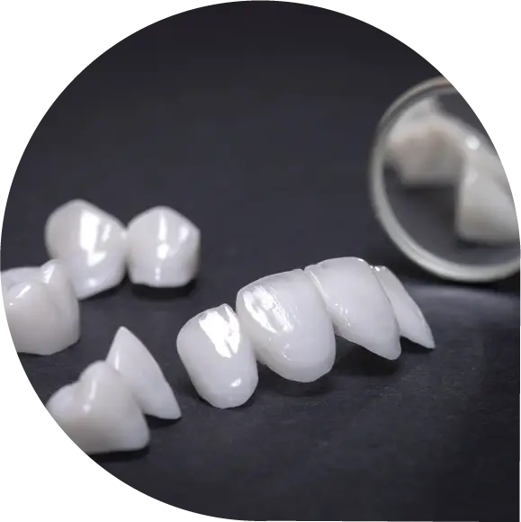 Lumina Dental showcases the Porcelain dental veneers, highlighting their bespoke, slim design for smile transformation.