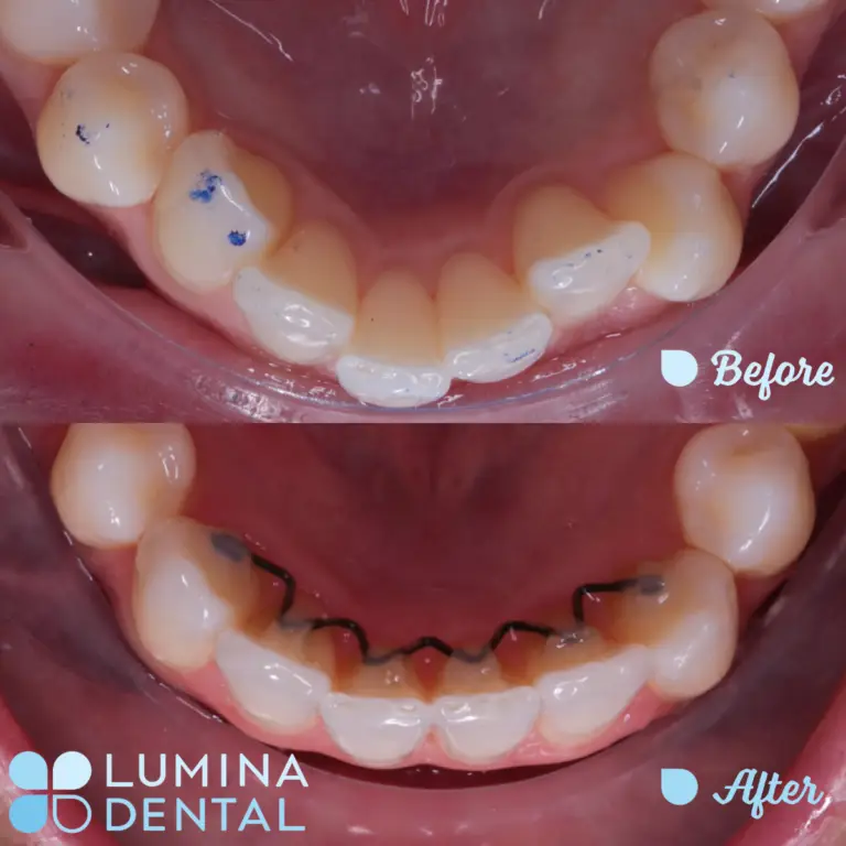 Lumina Ortho transformation teeth straightened and bite adjusted