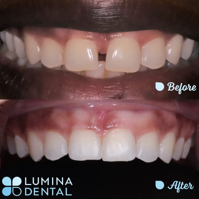 Lumina Dental Orthodonitcs Teeth Aligned