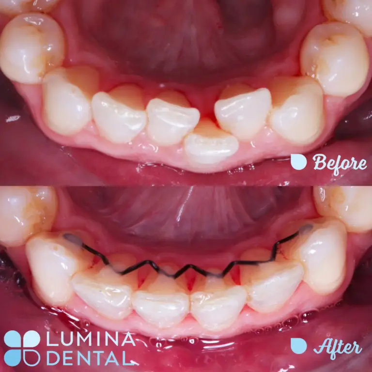 Lumina Orthodontics Teeth Straightened and Aligned