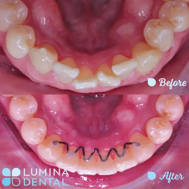 Lumina Dental Orthodontics 3D Movement Bites Corrected